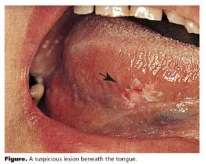 Detecting oral cancer early